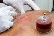حجامت برای چه کسانی ممنوع است؟