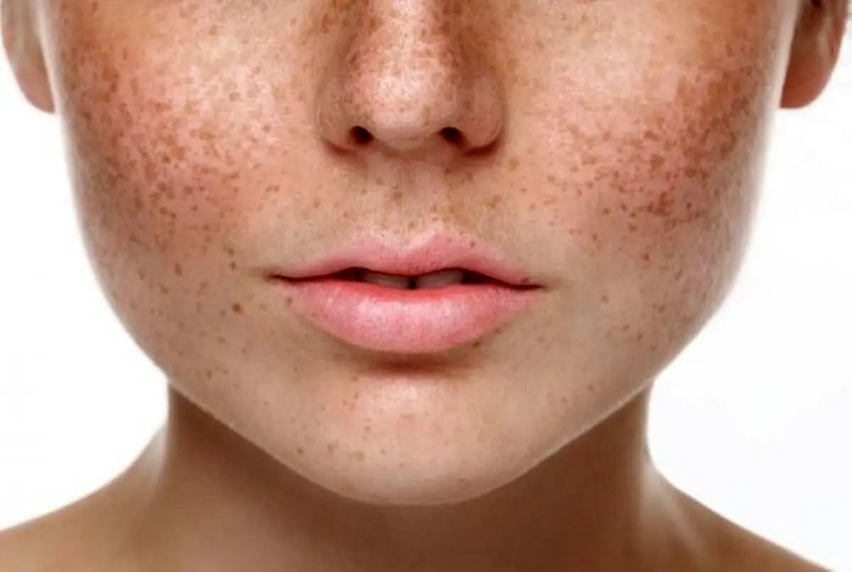ارتباط لکهای قهوه ای روی صورت با بیماری کبدی