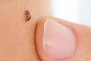 علائم خال‌های سرطانی را بشناسیم
