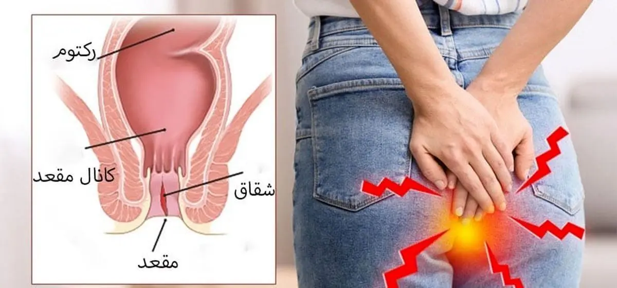 علل و علائم شقاق مقعد در زنان و روش های درمان