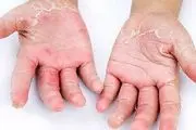 علائم و نشانه های پوستی کرونا چیست؟