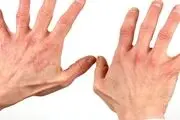 علل و راه‌های درمان بیماری پسوریازیس
