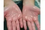 چه کنیم تا کف دستمان عرق نکند؟