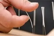 تاثیر طب سوزنی بر کاهش استرس
