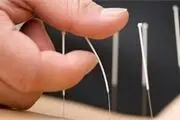 تاثیر طب سوزنی بر کاهش استرس
