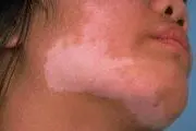 دلیل بیماری لک و پیس چیست؟