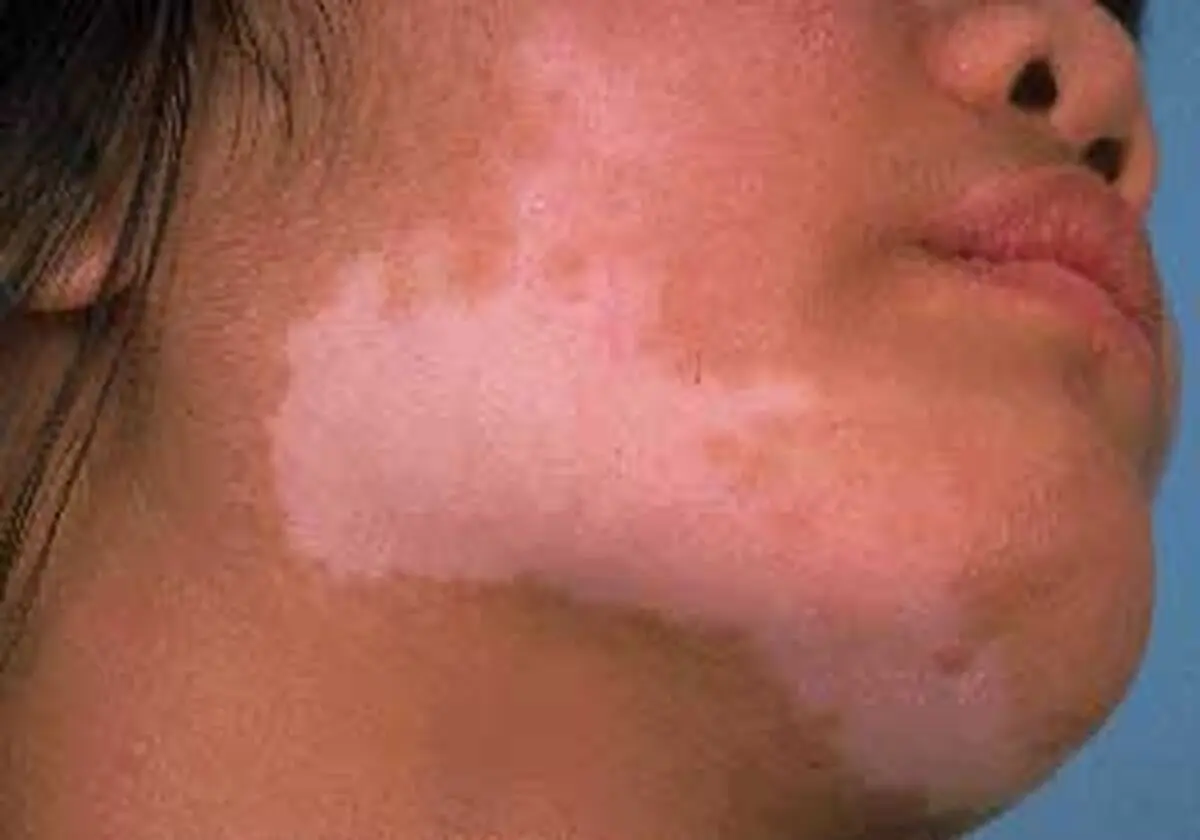 دلیل بیماری لک و پیس چیست؟