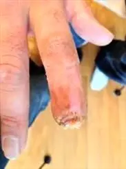 احیای انگشت قطع شده انسانی با مثانه خوک