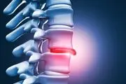 افراد دارای دیسک کمر چطور درمان می‌شوند؟