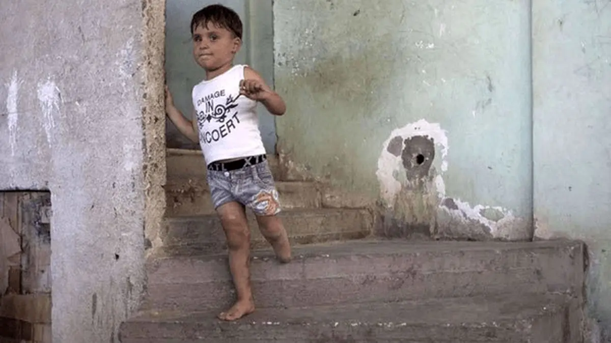 غزه؛ سرزمین کودکی برباد رفته و پاهای از دست رفته