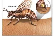 وقتی حشرات نیش می‌زنند چه باید بکنیم؟!