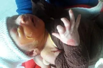 ماجرای سوختن نوزاد در بیمارستان صومعه سرا