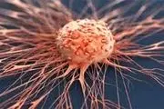 علائم زودهنگام دومین سرطان مرگبار جهان
