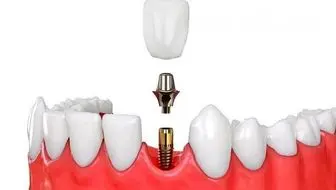 نوبت دهی دندانپزشکان متخصص ایمپلنت دندان  با پی جو