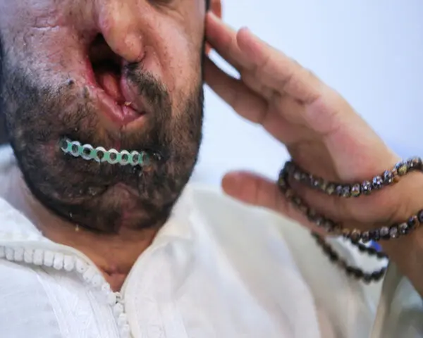 مجروحان یمنی در تهران