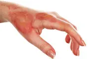 آفتاب سوختگی را چگونه درمان کنیم