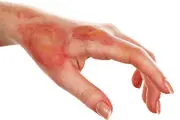 آفتاب سوختگی را چگونه درمان کنیم
