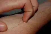 نحوه درمان اگزما