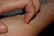 نحوه درمان اگزما