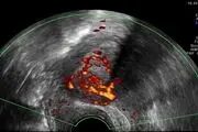 «آندو متریوز» چگونه درمان می‌شود؟
