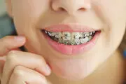 مناسب ترین سن ارتودنسی