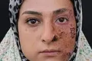 هراس از جذام| ۹۵ درصد جامعه مصونیت ذاتی به جذام دارند
