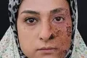 هراس از جذام| ۹۵ درصد جامعه مصونیت ذاتی به جذام دارند
