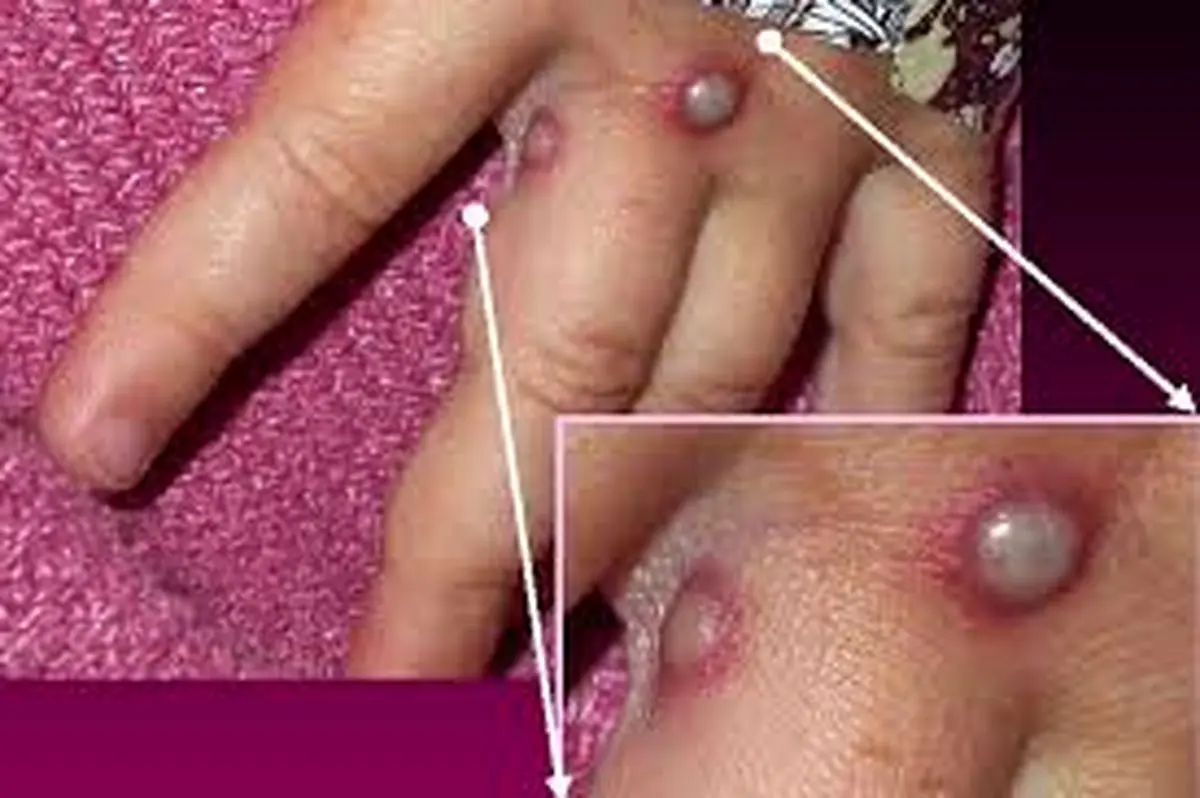 آبله میمون چیست؟| آبله میمون در نزدیکی مرزهای ایران| راه های سرایت بیماری آبله میمون