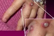 آبله میمون چیست؟| آبله میمون در نزدیکی مرزهای ایران| راه های سرایت بیماری آبله میمون