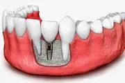 چگونه بدانیم ایمپلنت دندان عفونت کرده است؟