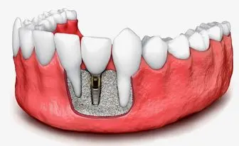 چگونه بدانیم ایمپلنت دندان عفونت کرده است؟