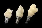 استفاده از ایمپلنت‌های نوین برای سالمندان فاقد دندان