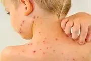 واکسیناسیون تمام کودکان زیر ۵ سال برای مقابله با سرخک ضرورت ندارد
