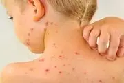 واکسیناسیون تمام کودکان زیر ۵ سال برای مقابله با سرخک ضرورت ندارد
