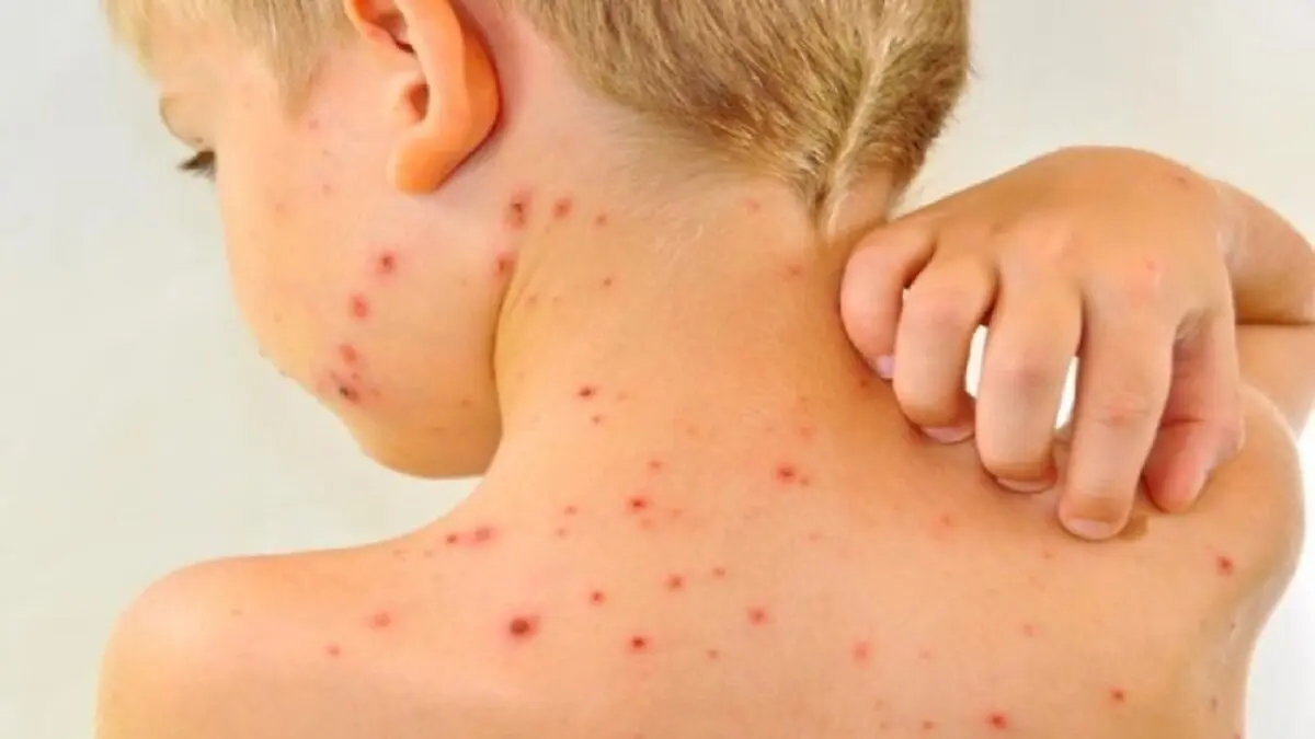 واکسیناسیون تمام کودکان زیر ۵ سال برای مقابله با سرخک ضرورت ندارد
