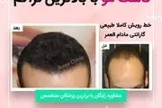 سن مناسب کاشت مو چقدر است ؟


