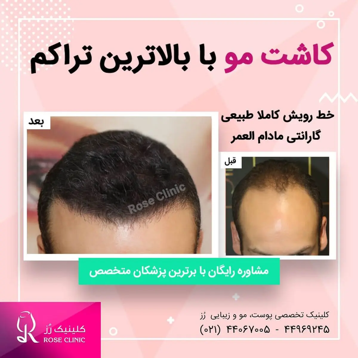 سن مناسب کاشت مو چقدر است ؟

