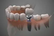 ایمپلنت دندان برای چه افرادی مناسب است؟