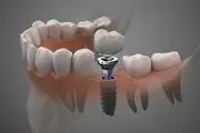 ایمپلنت دندان برای چه افرادی مناسب است؟
