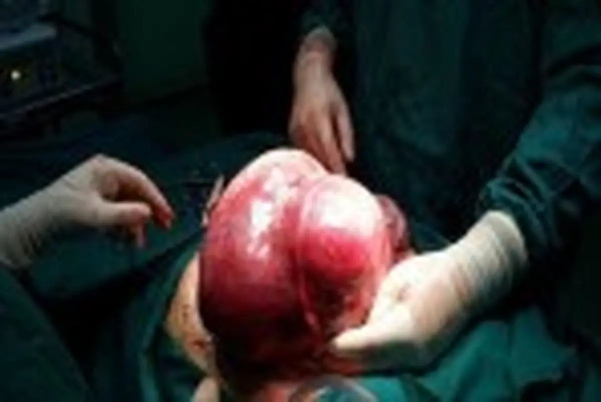 توده 11 کیلویی در شکم دختر 18 ساله+ عکس
