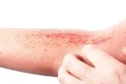 هرآنچه درباره بیماری درماتیت تماسی باید بدانید
