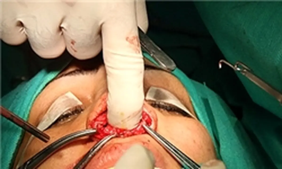 انجام ۶۵ عمل جراحی شکاف لب و سرطانهای صورت