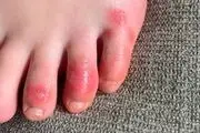 آیا انگشت پای کوویدی مرتبط با کرونا است؟