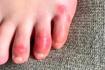 آیا انگشت پای کوویدی مرتبط با کرونا است؟