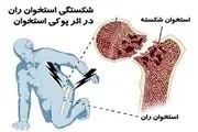پوکی استخوان را بیشتر بشناسید!