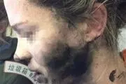 انفجار هدفون صورت مسافر را سوزاند+ عکس