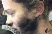 انفجار هدفون صورت مسافر را سوزاند+ عکس
