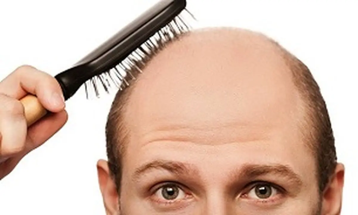 راهکار طبسنتی برای ریزش موی سکهای