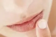 ۶ راه برای درمان ترک خوردگی لب