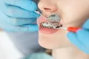 آشنایی با انواع ارتودنسی سریع مثل ارتودنسی نامرئی!
